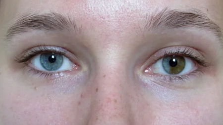 Sectoral Heterochromia: Condition Where One Part of Eye Is Different