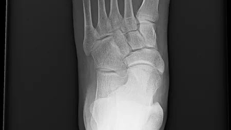 Tooth Growing Out of Foot