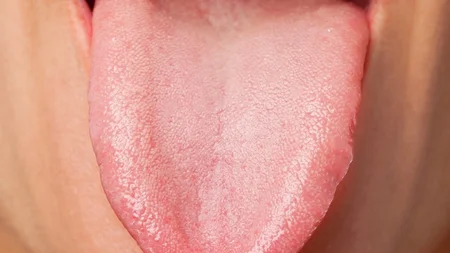 A white coating on your tongue indicates bacterial buildup - the thicker and whiter the coating, the